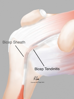 Bicep Tendinitis