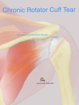 Chronic Rotator Cuff Tear