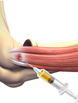 Cortisone vs. PRP for Elbow Pain (revisited)