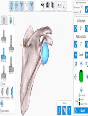 GPS Guidance for Shoulder Replacement