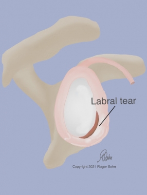 Labral Tear