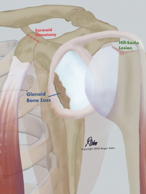 Latarjet Procedure