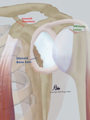 Latarjet Procedure