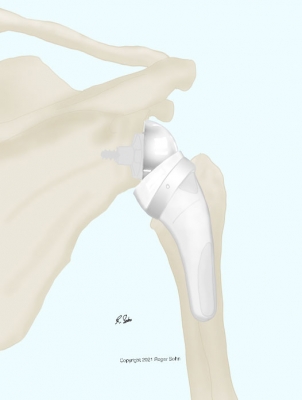 Reverse Shoulder Replacement Mechanics