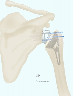 Reverse Total Shoulder Replacement Mechanics