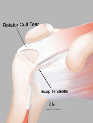 Rotator Cuff Tear