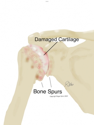 Shoulder Arthritis