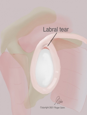 SLAP Tear Revisited