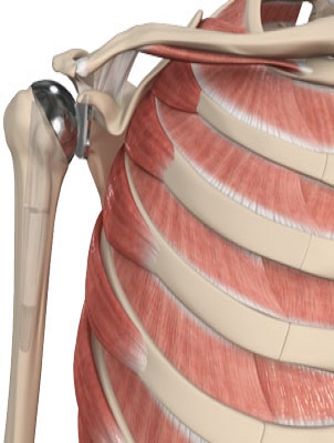 What Is It Like To Have A Shoulder Replacement?