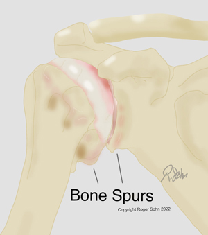 Arthritis of the Shoulder