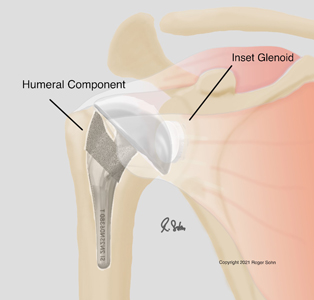 Arthritis of the Shoulder 2