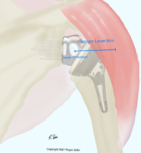 Arthritis of the Shoulder 3