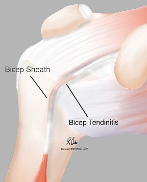 Bicep Tendinitis