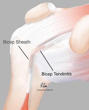 Bicep Tendinitis