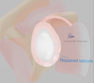 Labral Repair