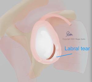 Labral Tear