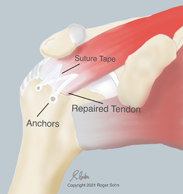 Rotator Cuff Repair Fountain Valley  Rotator Cuff Repair Surgeon San Juan  Capistrano