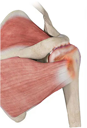 Rotator Cuff Arthropathy